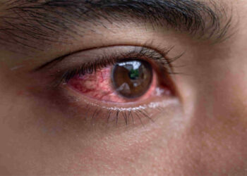 बच्चों से लेकर बड़ों तक में तेजी से फैल रहा आई फ्लू